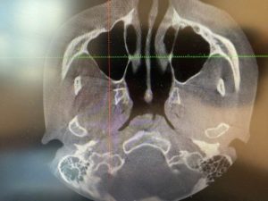 PLANMECA CBCT ProMax 3D Mid Dental