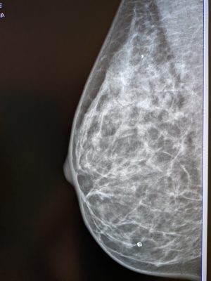 Siemens Mammomat Inspiration Mammography