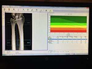 GE Aria Bone Densitometry