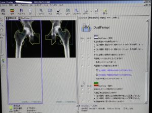 GE Lunar PRODIGY Bone Densitometry