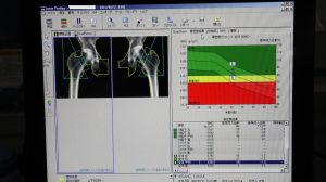 GE Lunar PRODIGY Bone Densitometry
