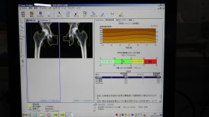 GE Lunar PRODIGY Bone Densitometry