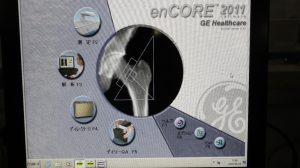 GE Lunar PRODIGY Bone Densitometry