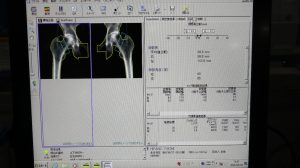 GE Lunar PRODIGY Bone Densitometry