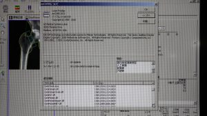 GE Lunar PRODIGY Bone Densitometry