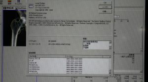 GE Lunar PRODIGY Bone Densitometry