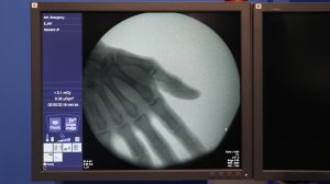 SIEMENS Cios Select Angio - C Arm