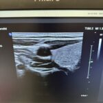PHILIPS Probe L12-3 Probe