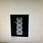 Hologic Bone Densitometer Discovery-YOM 2010 Hologic Discovery-YOM 2010 Bone Densitometer