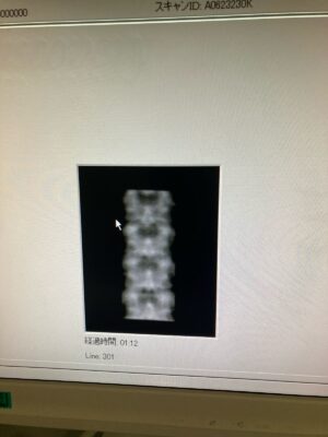 Hologic Bone Densitometer Discovery-YOM 2010 Hologic Discovery-YOM 2010 Bone Densitometer