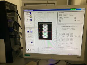 Hologic Bone Densitometer Discovery-YOM 2010 Hologic Discovery-YOM 2010 Bone Densitometer