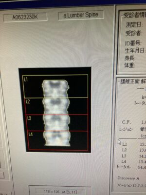 Hologic Bone Densitometer Discovery-YOM 2010 Hologic Discovery-YOM 2010 Bone Densitometer