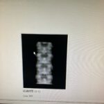 Hologic Bone Densitometer Discovery-YOM 2010 Hologic Discovery-YOM 2010 Bone Densitometer