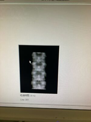 Hologic Bone Densitometer Discovery-YOM 2010 Hologic Discovery-YOM 2010 Bone Densitometer