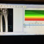 GE Aria Bone Densitometer